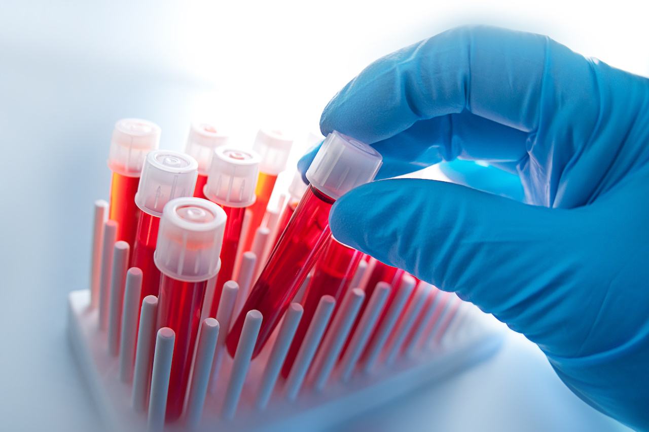 dexamethasone suppression test