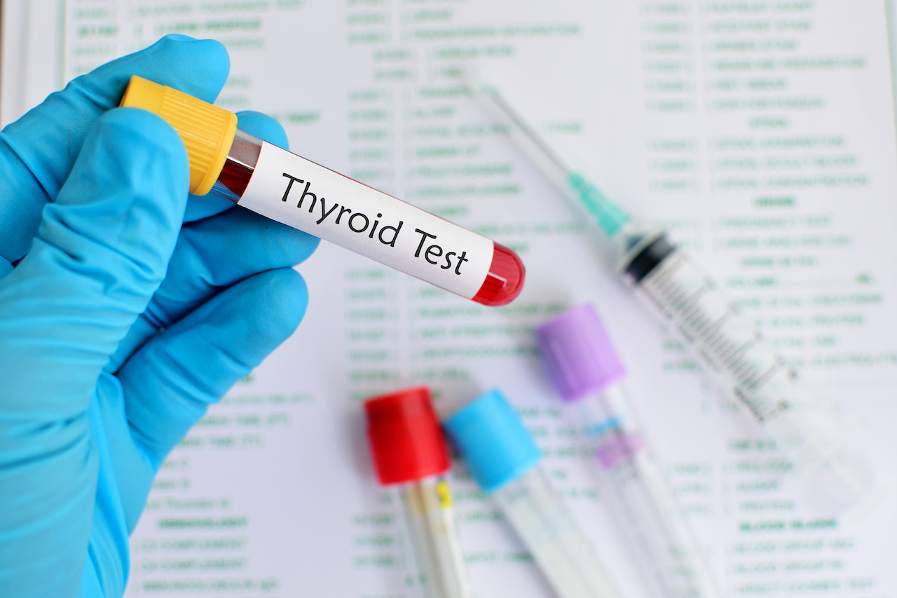 T3 Test High T3 Uptake Test